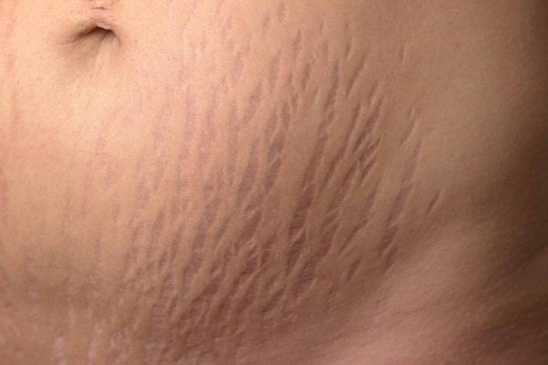 Stretch mark & Scars “Be gone” package