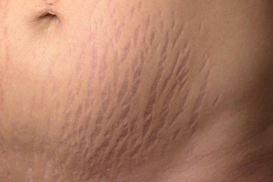 Stretch mark & Scars “Be gone” package