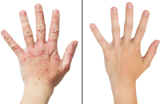 Eczema “Be gone” Package